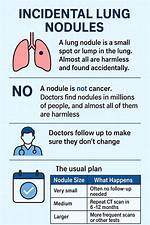 Can Lung Nodules Disappear with Chemo?