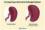 Does an Enlarged Spleen Cause Bloating?