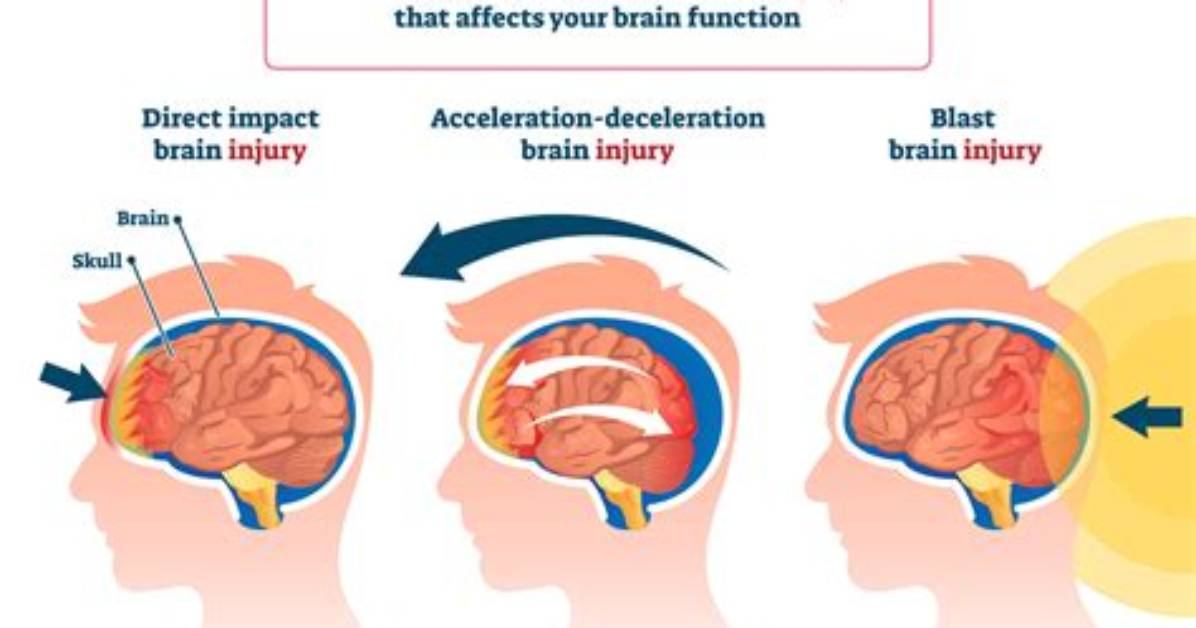 How Do You Treat a Concussion in a Child?