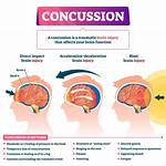 How Do You Treat a Concussion in a Child?