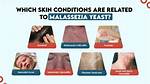 What Kills Malassezia Yeast on Skin?